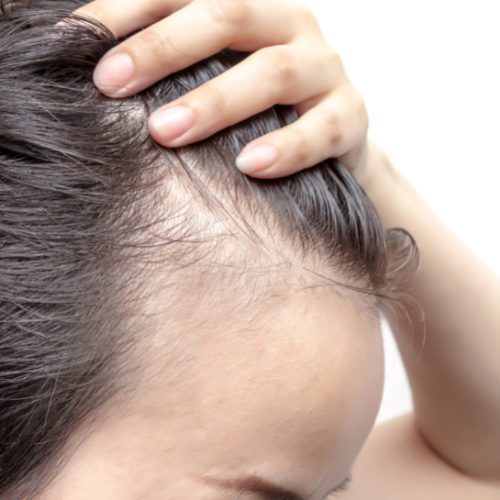 Alopecia