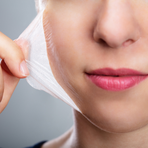 Quimioexfoliación Peeling
