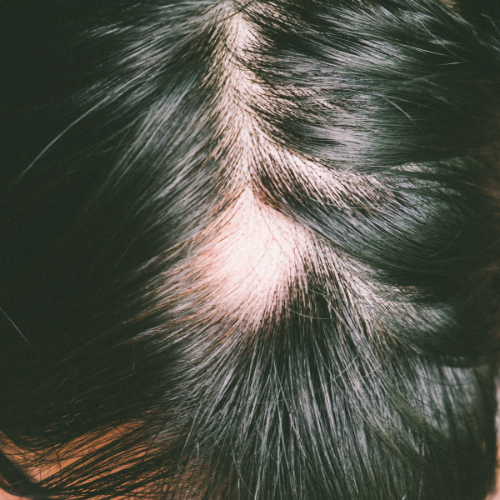 Alopecia Areata
