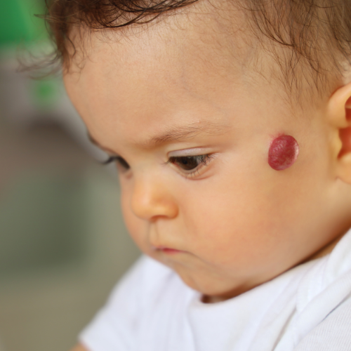 Malformaciones vasculares y hemangiomas
